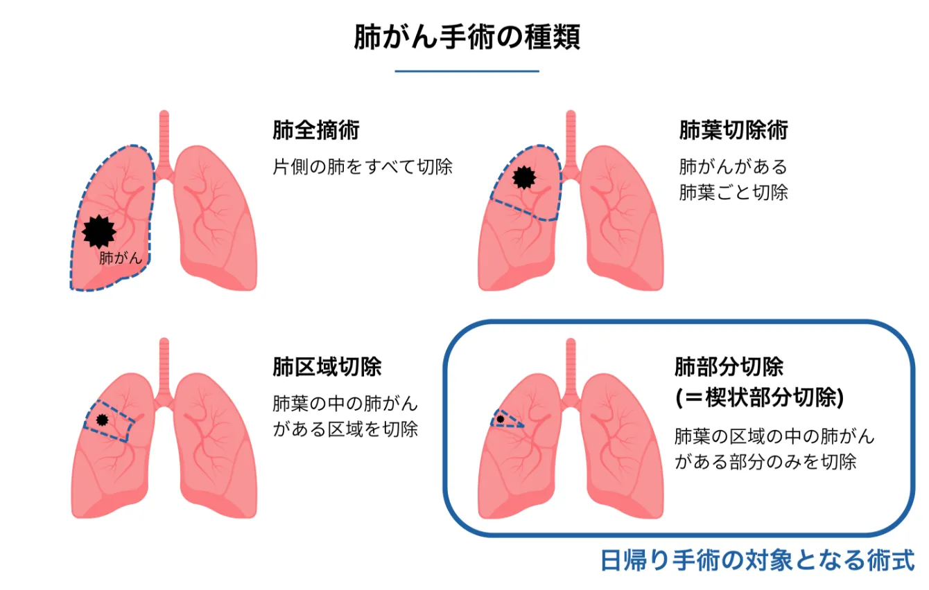 肺がん手術の種類
