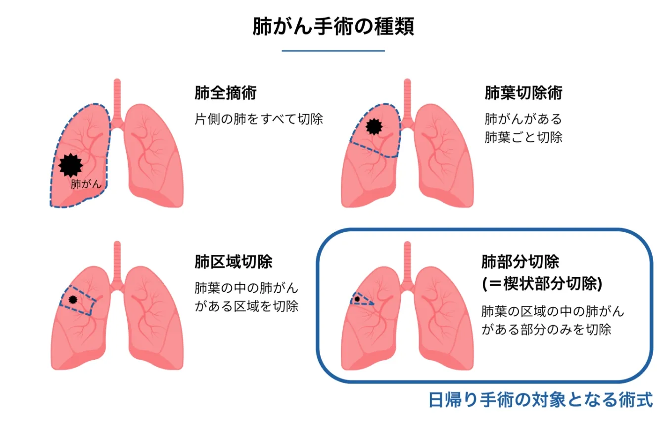 肺がん手術の種類