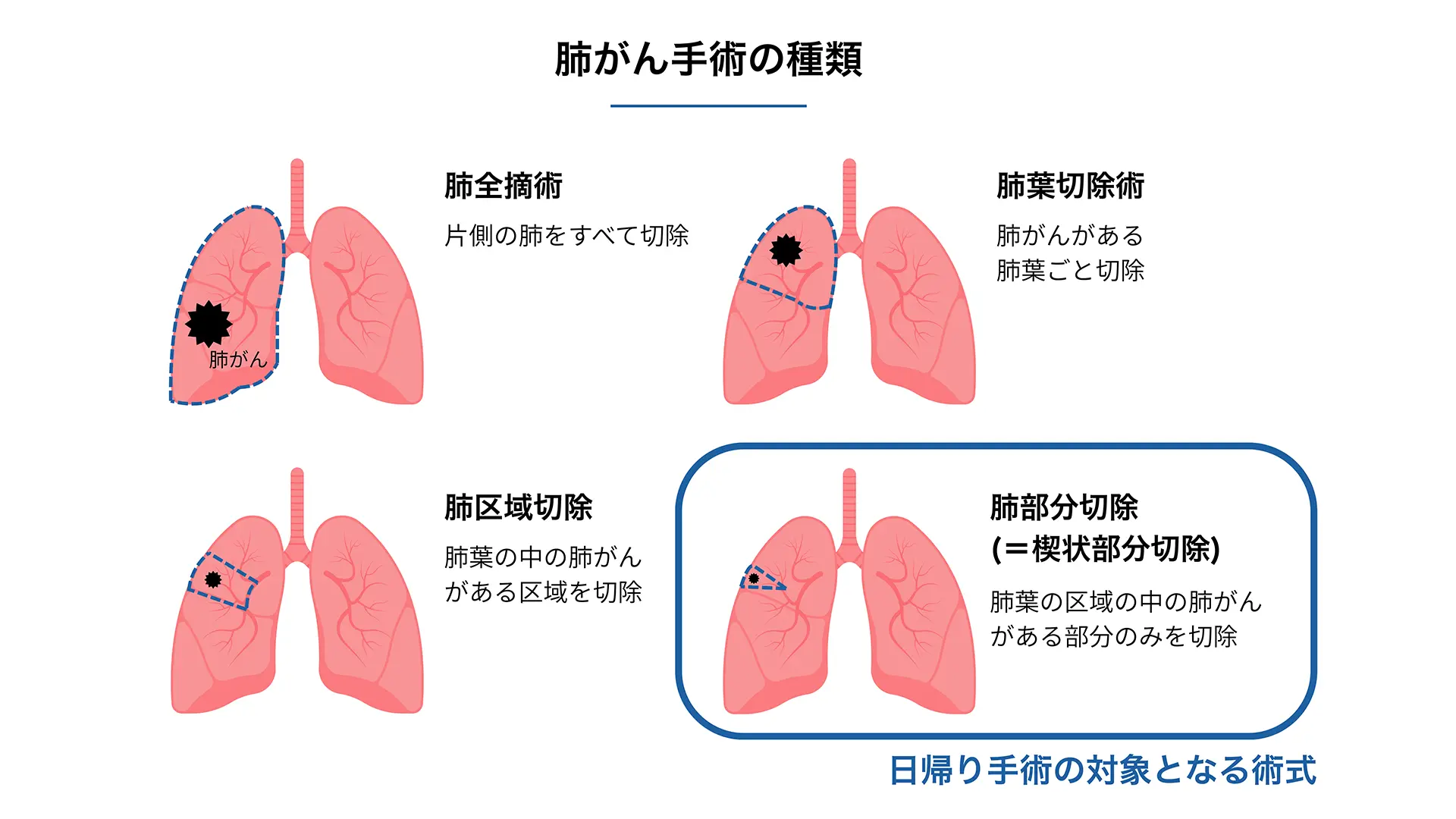 肺がん手術を検討中の患者様へ｜東京日本橋 早期肺がん日帰り手術