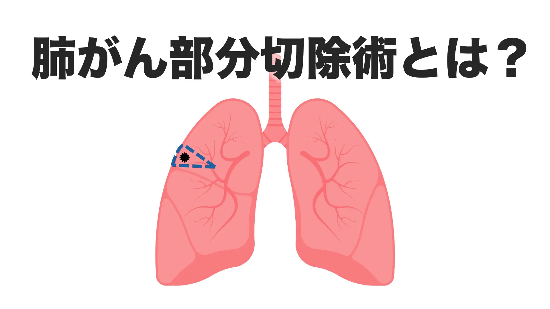 肺がん部分切除術とは？