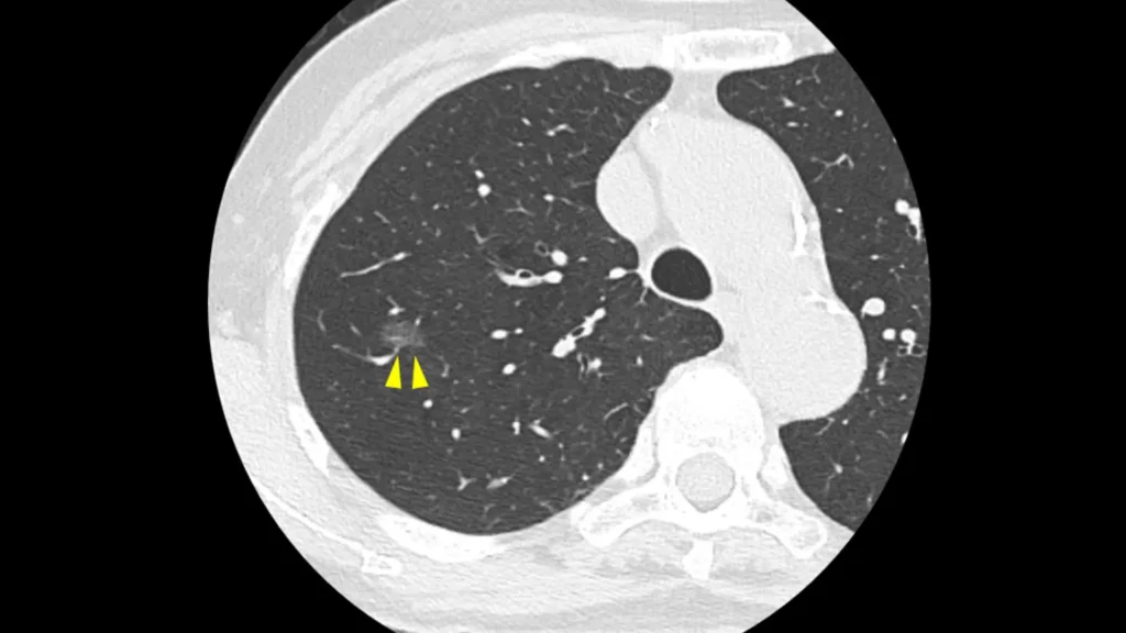 早期肺がんCT