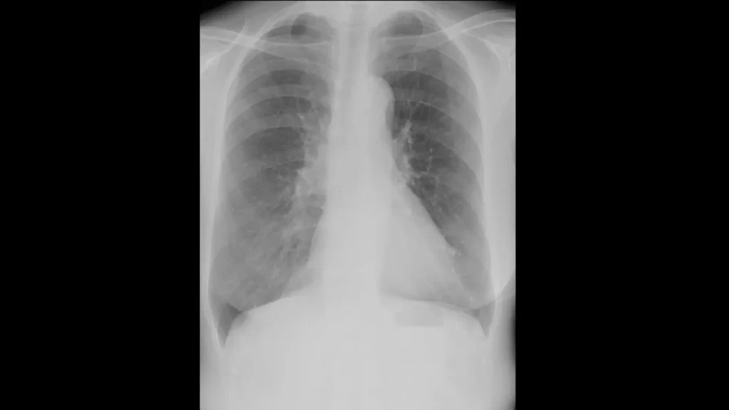 ③の患者さんの胸部X線(CTとの比較