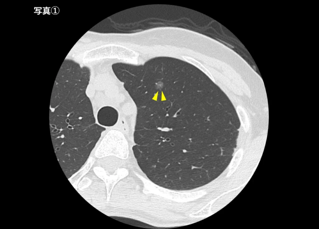 すりガラス影を伴う肺がん（写真①）