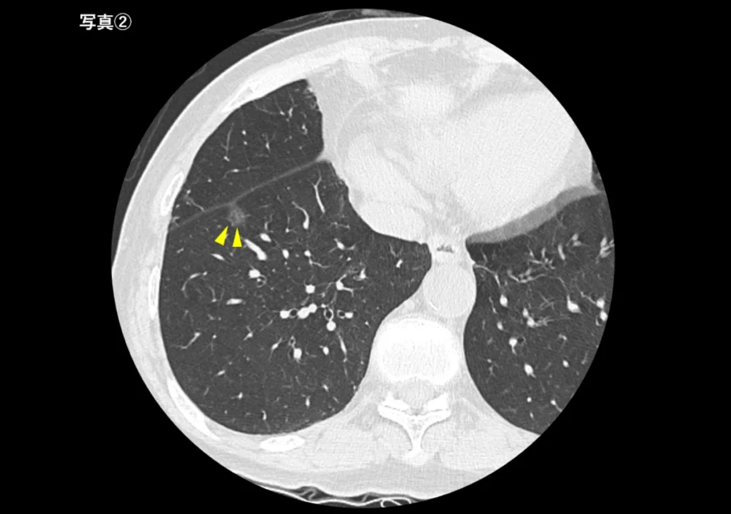 小さな肺がん（写真②）