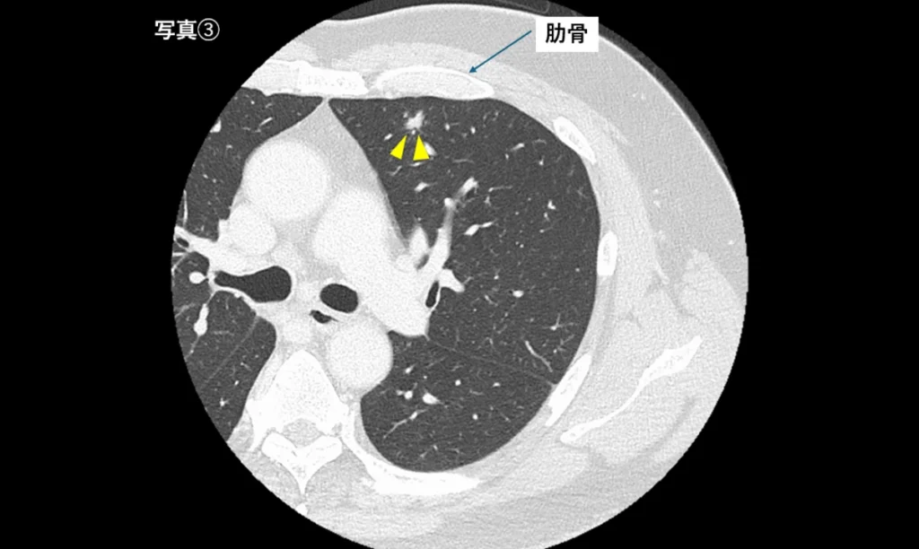 肋骨の裏側にある腫瘍（写真③）
